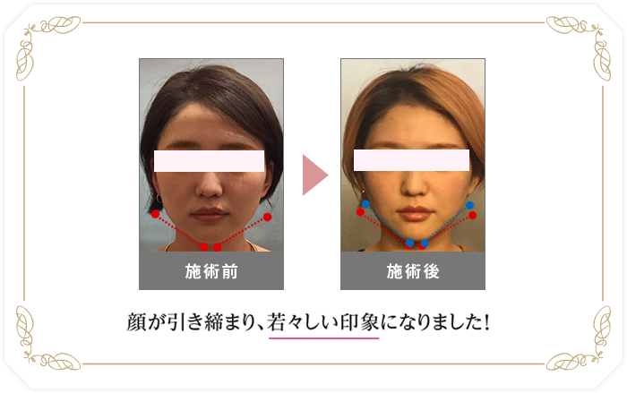 左右のバランスが整い、歪みが解消されました！