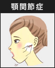 顎関節症
